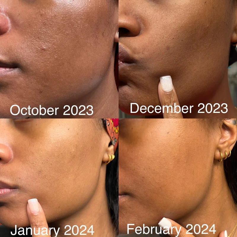 Dark Spot Eraser Moisturizer