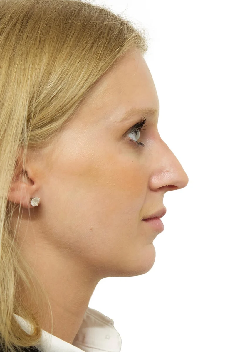 Copy of Dorsal Hump Reduction