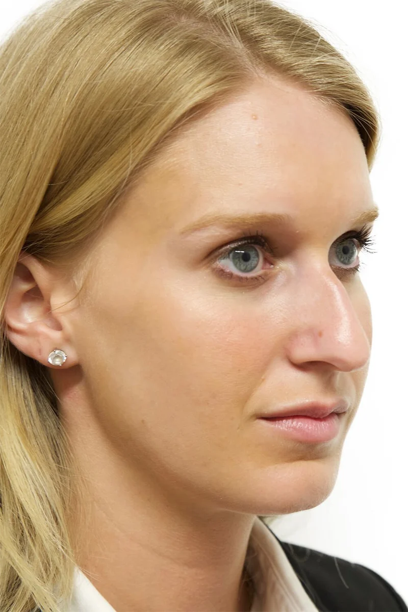 Copy of Dorsal Hump Reduction